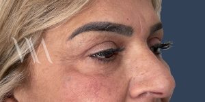 After blepharoplasty by Dr. William Watfa