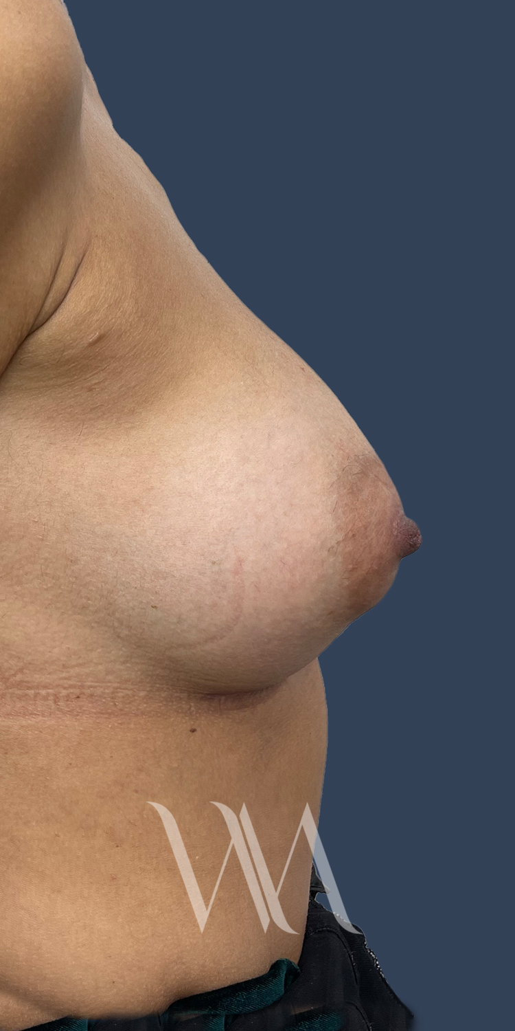 after breast augmentation by Dr. William Watfa