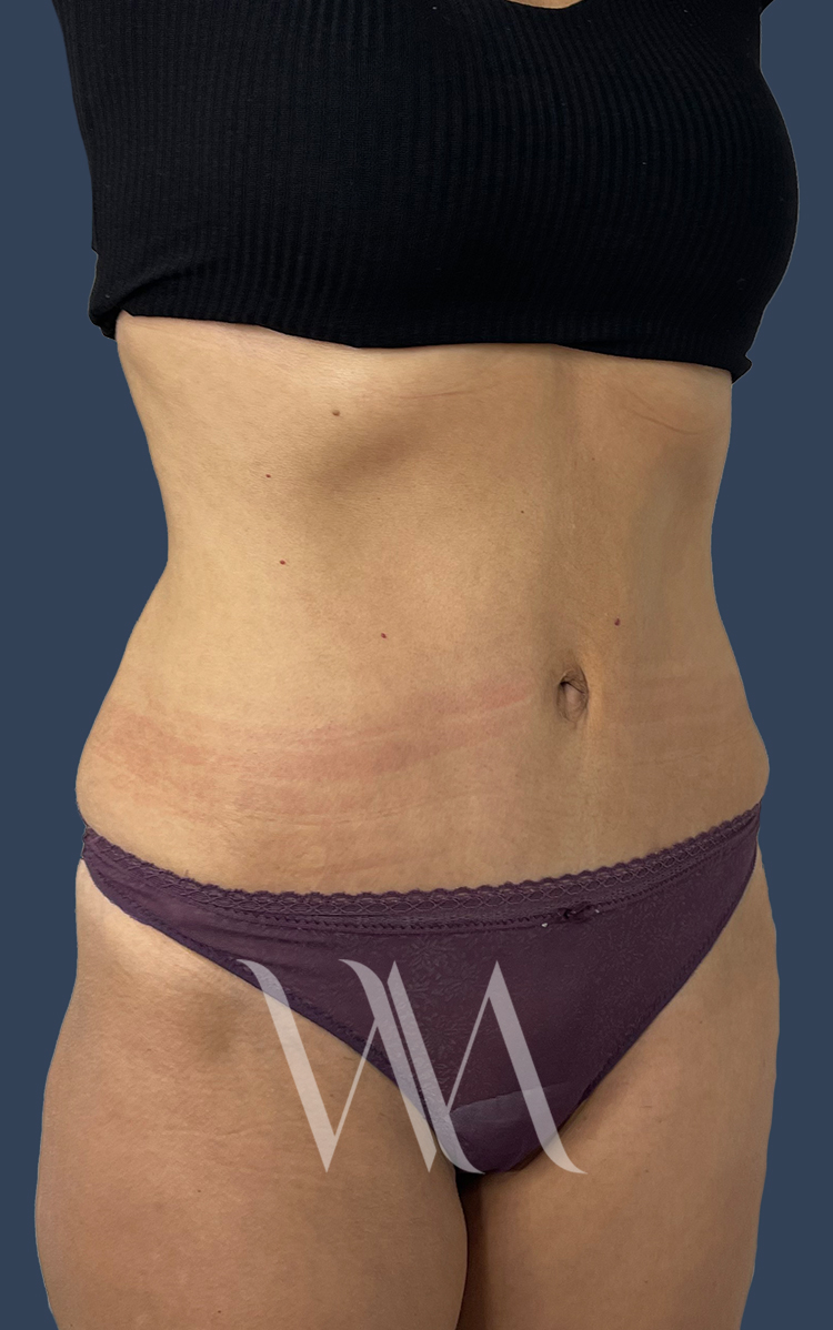 After tummy tuck by Dr. William Watfa
