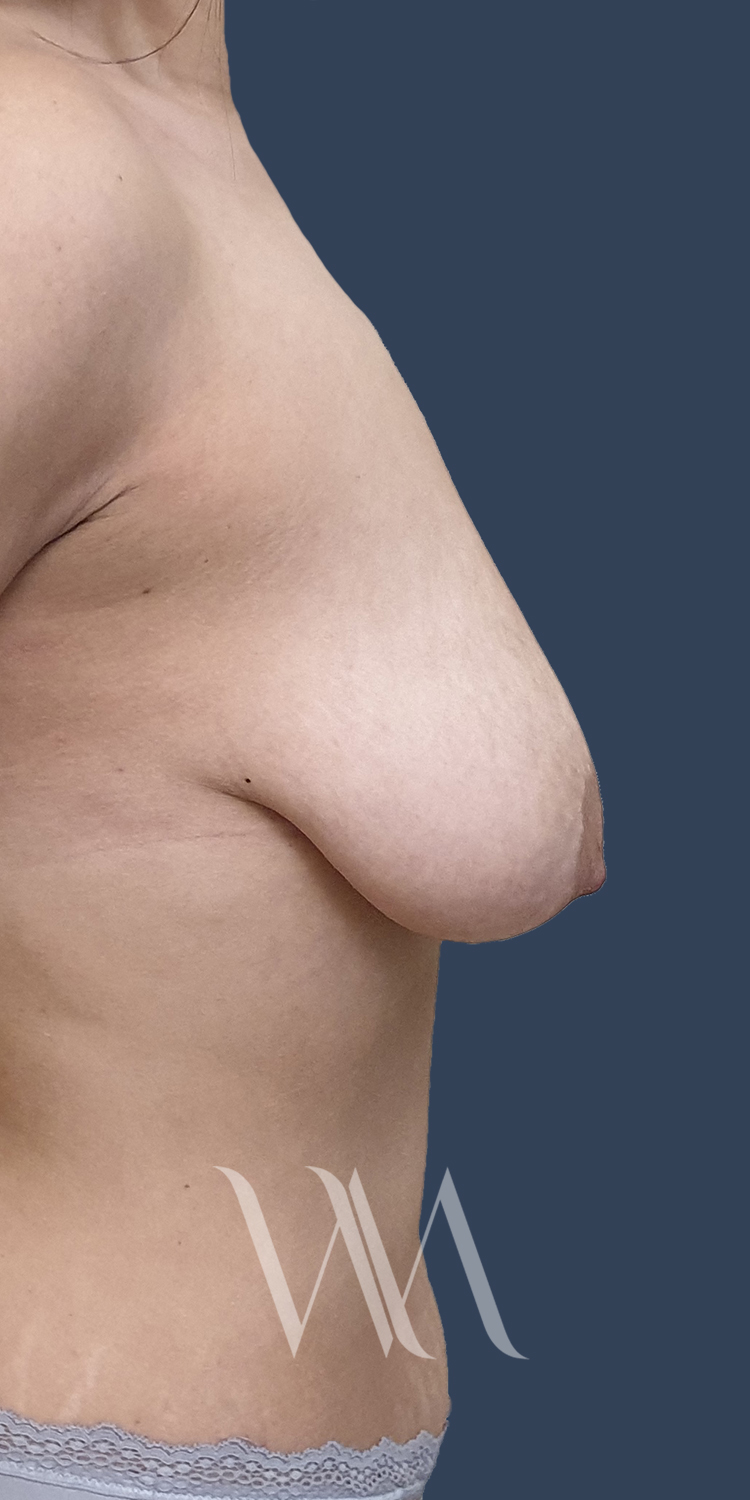 Before breast lift by Dr. William Watfa