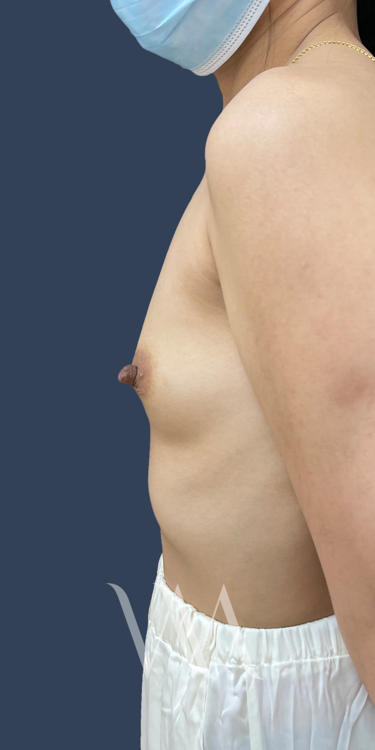 before breast augmentation by Dr. William Watfa