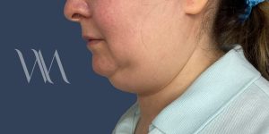 Before double chin liposuction by Dr. William Watfa