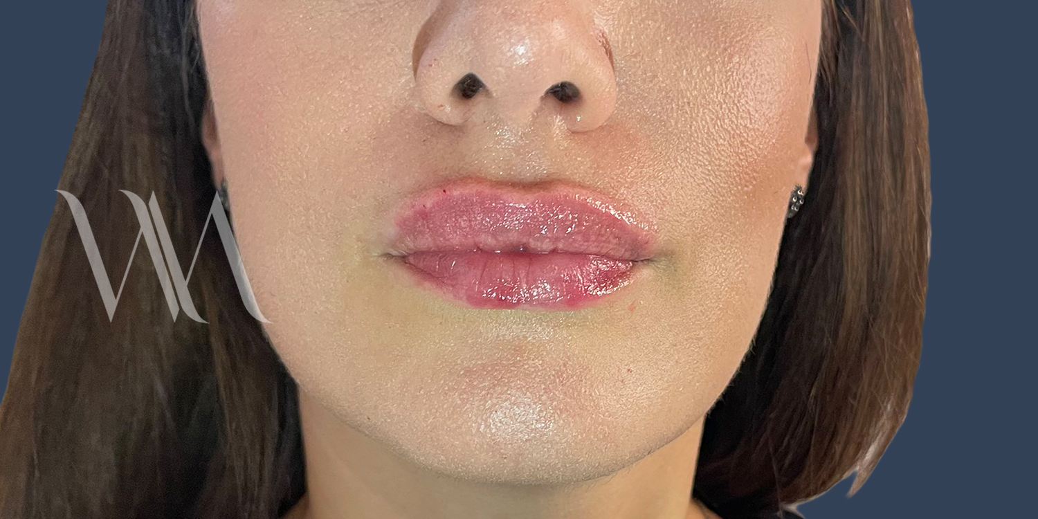 After russian lip filler by Dr William Watfa